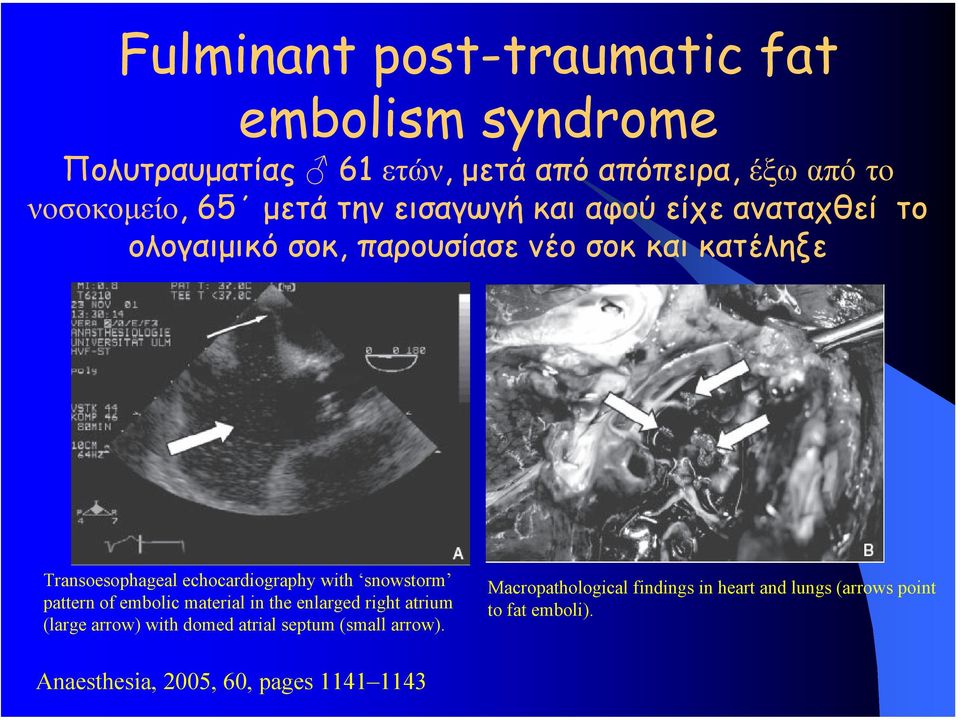 echocardiography with snowstorm pattern of embolic material in the enlarged right atrium (large arrow) with domed atrial