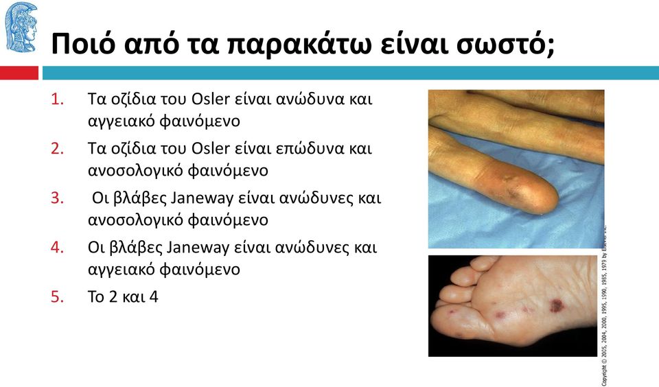 Τα οζίδια του Osler είναι επώδυνα και ανοσολογικό φαινόμενο 3.