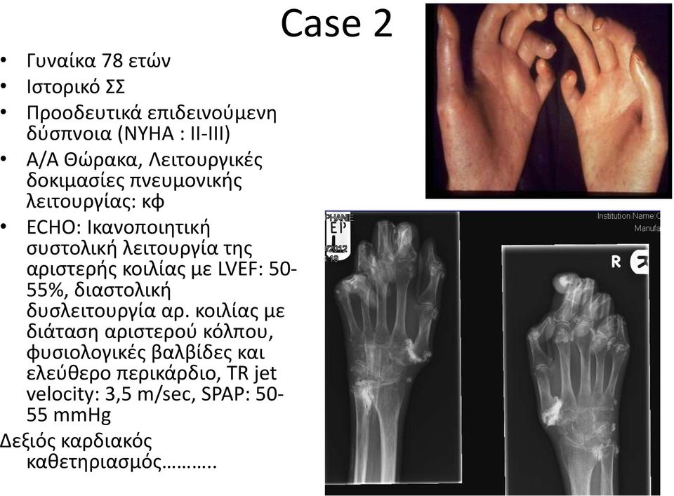 LVEF: 50-55%, διαστολική δυσλειτουργία αρ.