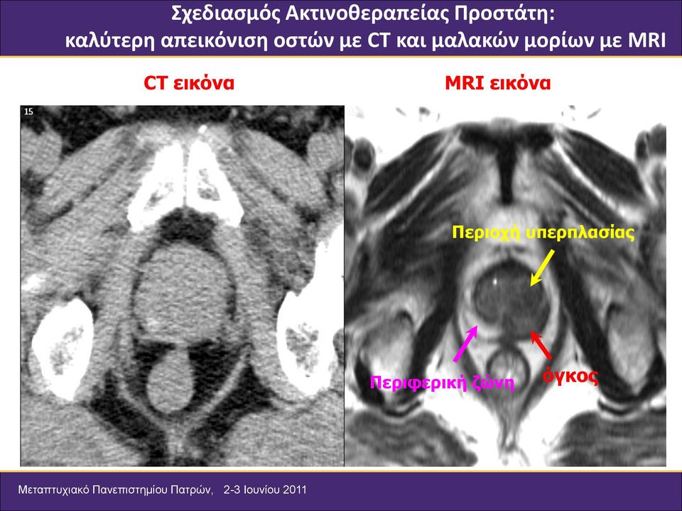 μαλακών μορίων με MRI CT εικόνα MRI