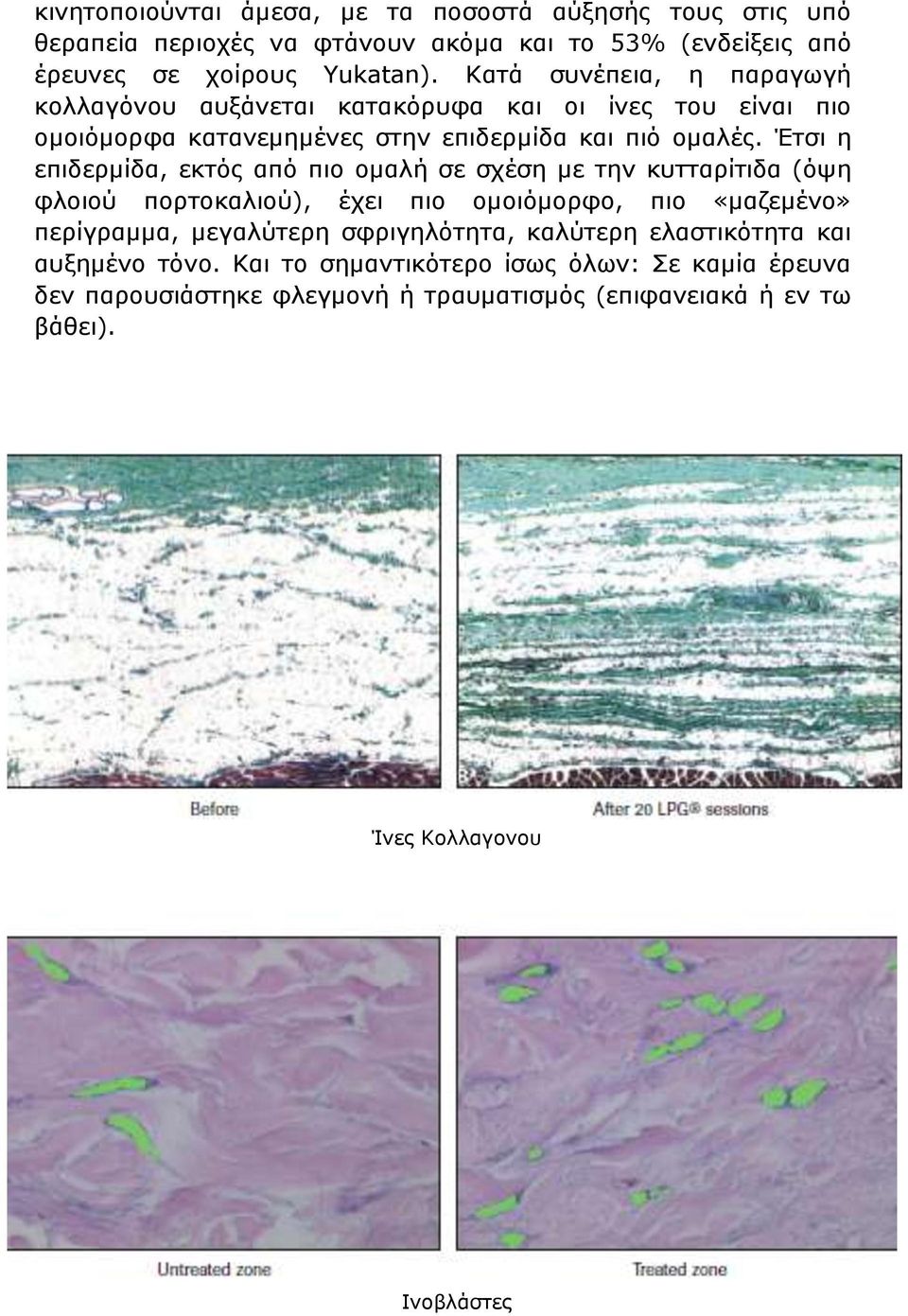 Έτσι η επιδερμίδα, εκτός από πιο ομαλή σε σχέση με την κυτταρίτιδα (όψη φλοιού πορτοκαλιού), έχει πιο ομοιόμορφο, πιο «μαζεμένο» περίγραμμα, μεγαλύτερη