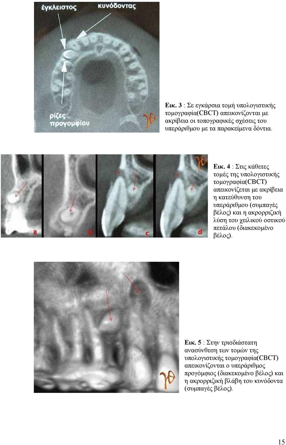 4 : Στις κάθετες τοµές της υπολογιστικής τοµογραφία(cbct) απεικονίζεται µε ακρίβεια η κατεύθυνση του υπεράριθµου (συµπαγές βέλος) και η