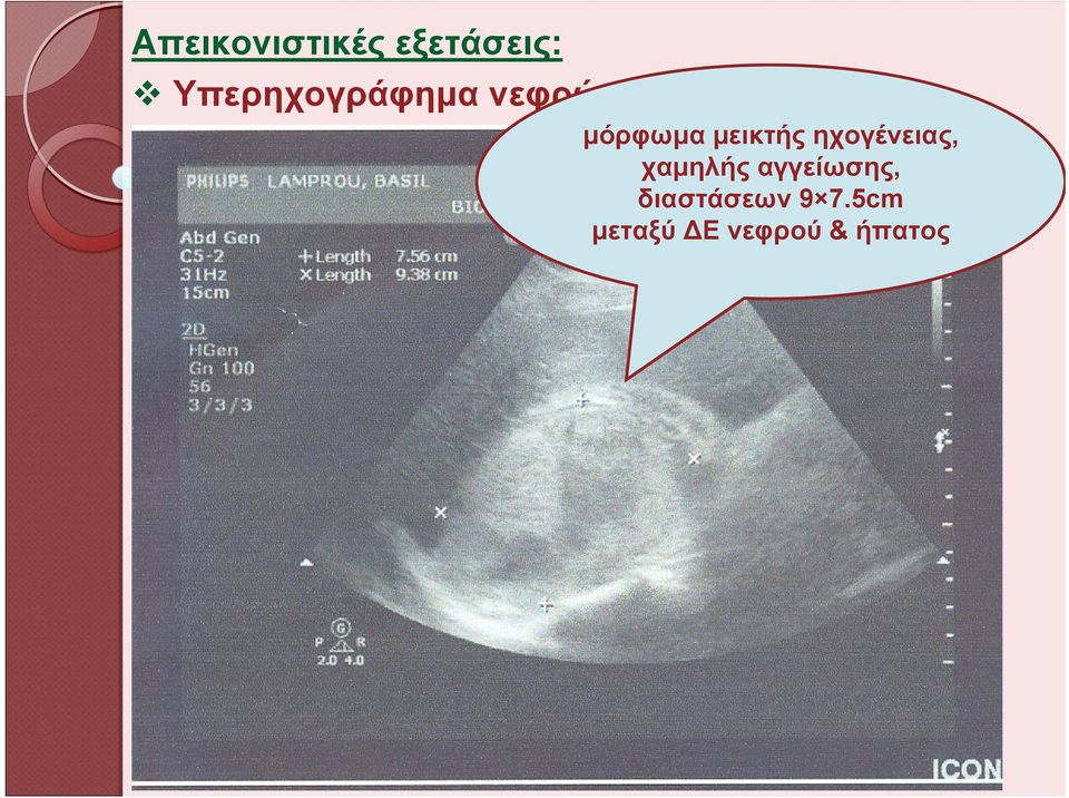 μεικτής ηχογένειας, χαμηλής