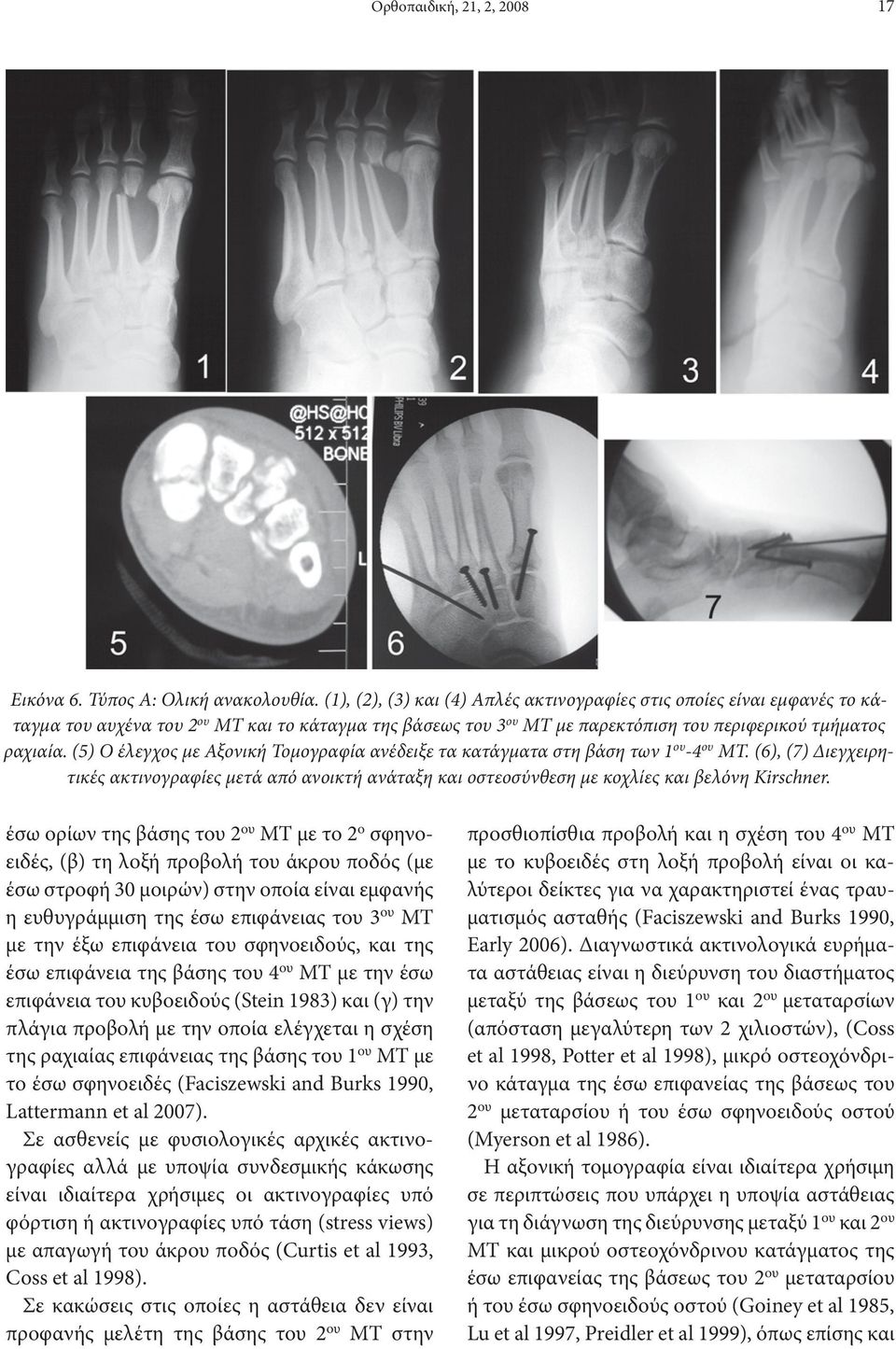 (5) Ο έλεγχος με Αξονική Τομογραφία ανέδειξε τα κατάγματα στη βάση των 1 ου -4 ου ΜΤ. (6), (7) Διεγχειρητικές ακτινογραφίες μετά από ανοικτή ανάταξη και οστεοσύνθεση με κοχλίες και βελόνη Kirschner.