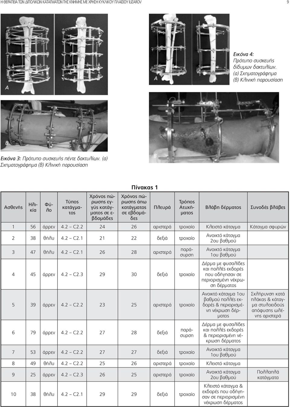 (α) Σχηματογράφημα (β) Κλινική παρουσίαση B Πίνακας 1 Χρόνος πώρωσης Χρόνος πώ- Ασθενής εγρωσης άπω Τρόπος Τύπος Ηλικίλο Φύ- κατάγματοματος σε ε- σε εβδομάματογύς κατάγ- κατάγματος Πλευρά Ατυχή-