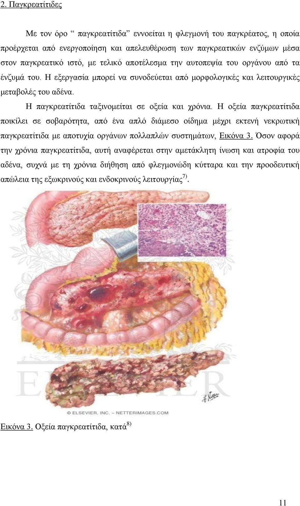 Η οξεία παγκρεατίτιδα ποικίλει σε σοβαρότητα, από ένα απλό διάμεσο οίδημα μέχρι εκτενή νεκρωτική παγκρεατίτιδα με αποτυχία οργάνων πολλαπλών συστημάτων, Εικόνα 3.