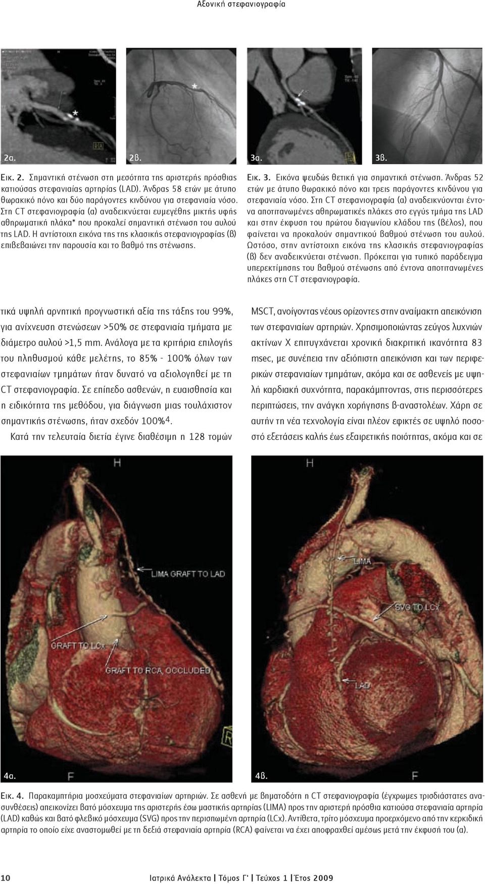 Στη CT στεφανιογραφία (α) αναδεικνύεται ευμεγέθης μικτής υφής αθηρωματική πλάκα* που προκαλεί σημαντική στένωση του αυλού της LAD.