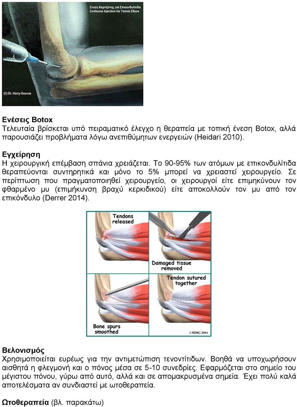Σε περίπτωση που πραγματοποιηθεί χειρουργείο, οι χειρουργοί είτε επιμηκύνουν τον φθαρμένο μυ (επιμήκυνση βραχύ κερκιδικού) είτε αποκολλούν τον μυ από τον επικόνδυλο (Derrer 2014).