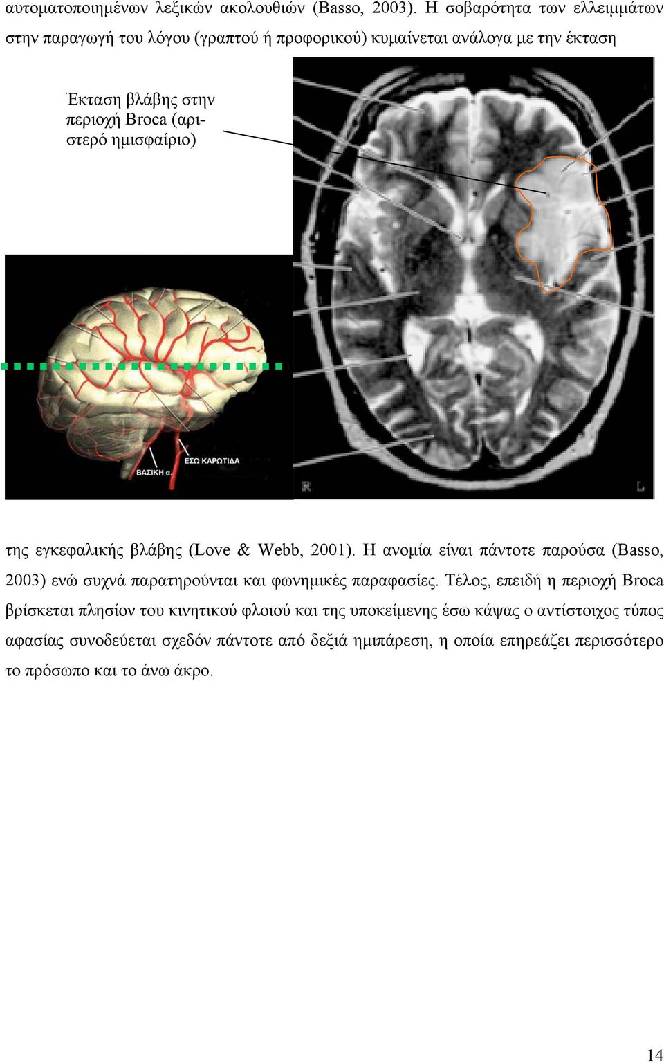 (αριστερό ημισφαίριο) της εγκεφαλικής βλάβης (Love & Webb, 2001).