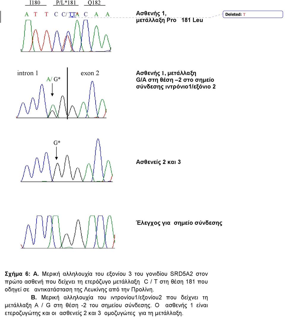 Μερική αλληλουχία του εξονίου 3 του γονιδίου SRD5A2 στον πρώτο ασθενή που δείχνει τη ετερόζυγο µετάλλαξη C / T στη θέση 181 που οδηγεί σε αντικατάσταση
