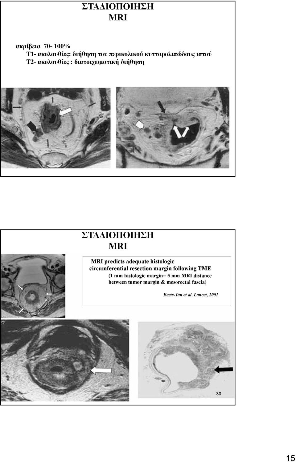 histologic circumferential resection margin following TME (1 mm histologic margin= 5