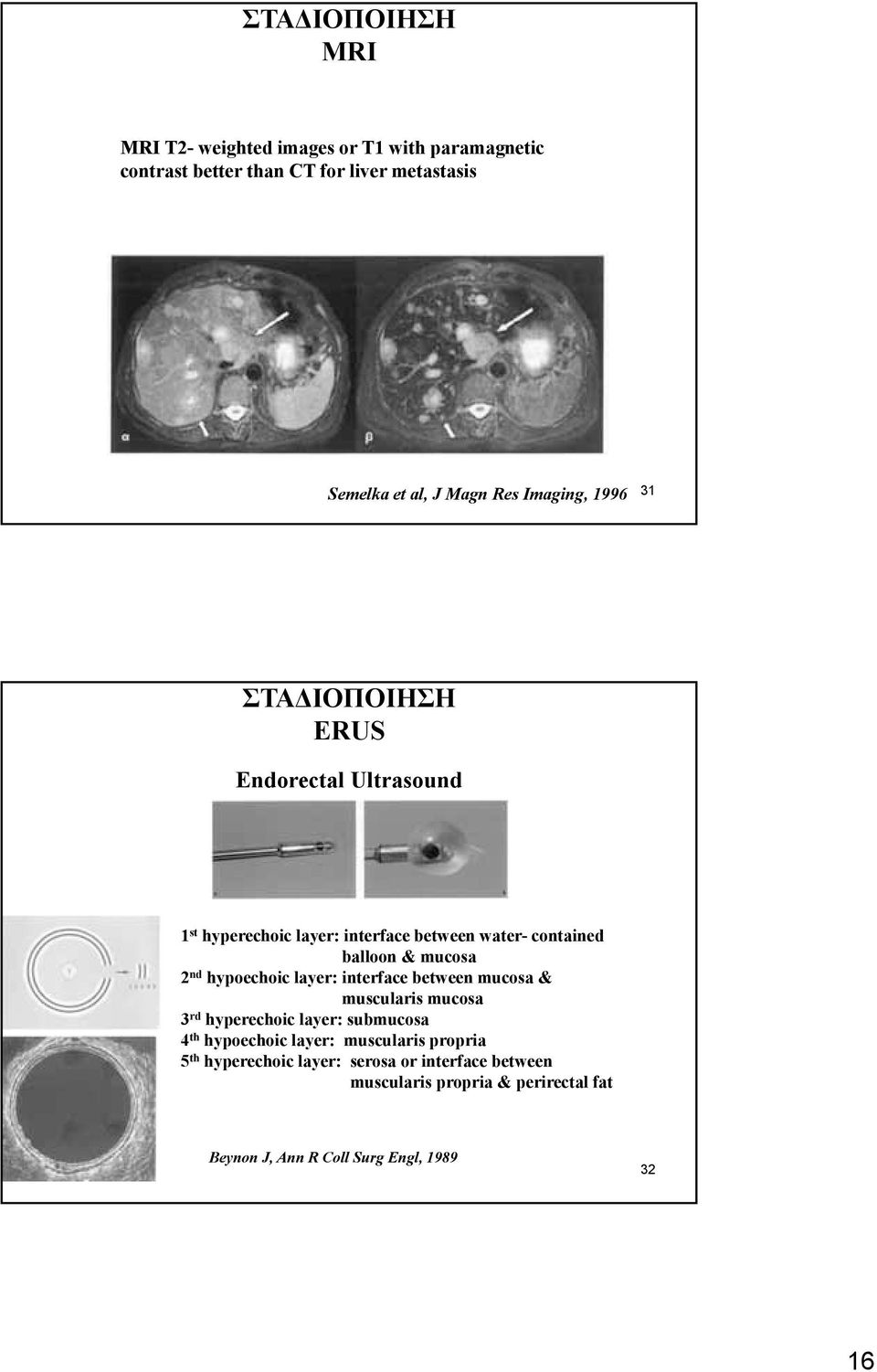 hypoechoic layer: interface between mucosa & muscularis mucosa 3 rd hyperechoic layer: submucosa 4 th hypoechoic layer: