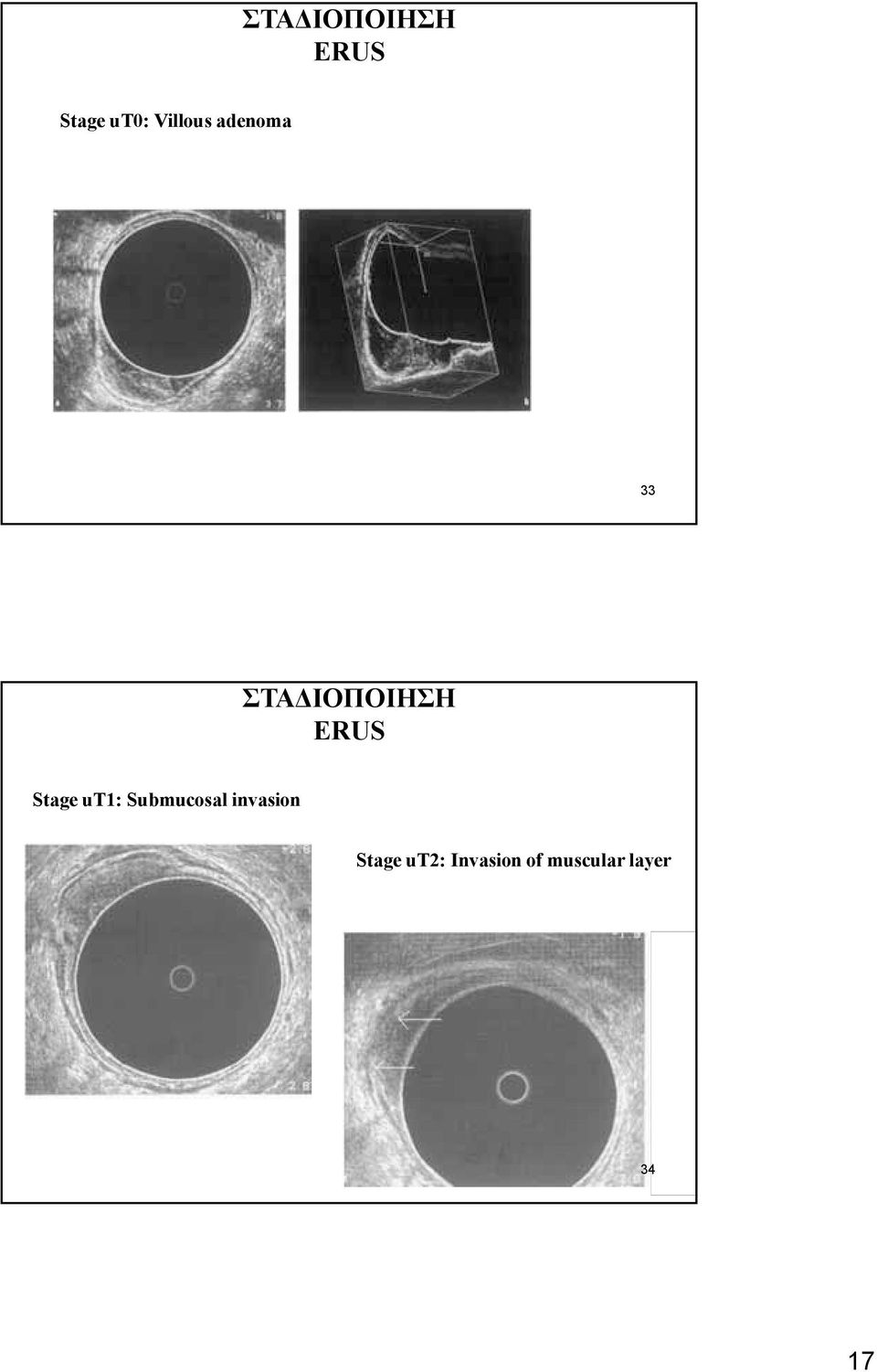 Submucosal invasion Stage