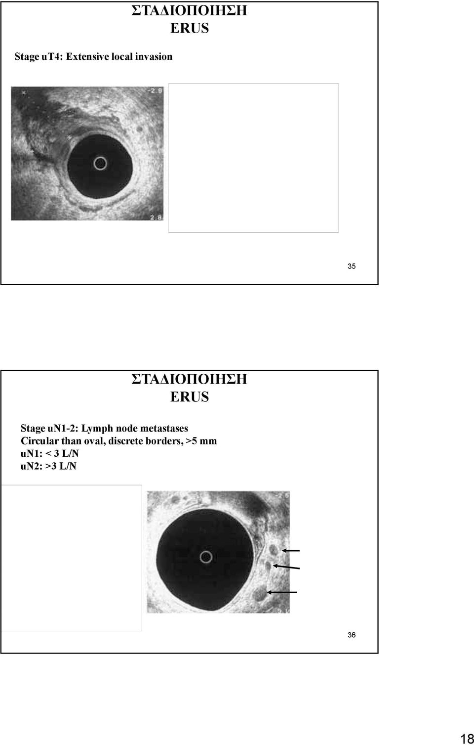 metastases Circular than oval, discrete