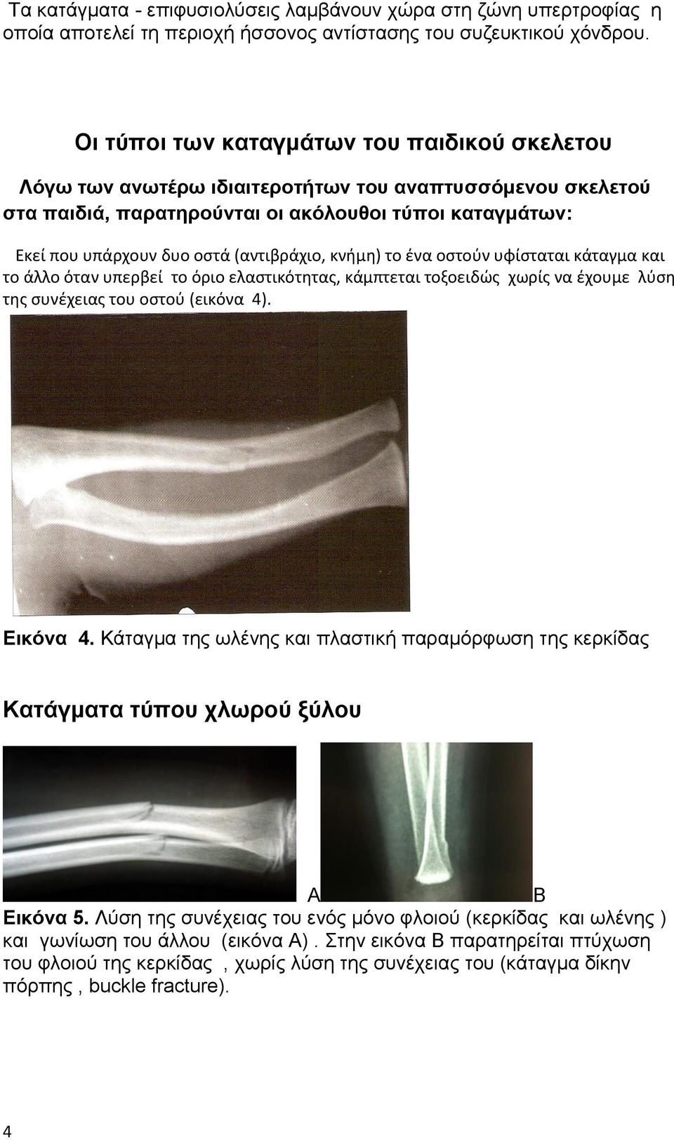 (αντιβράχιο, κνήμη) το ένα οστούν υφίσταται κάταγμα και το άλλο όταν υπερβεί το όριο ελαστικότητας, κάμπτεται τοξοειδώς χωρίς να έχουμε λύση της συνέχειας του οστού (εικόνα 4). Εικόνα 4.