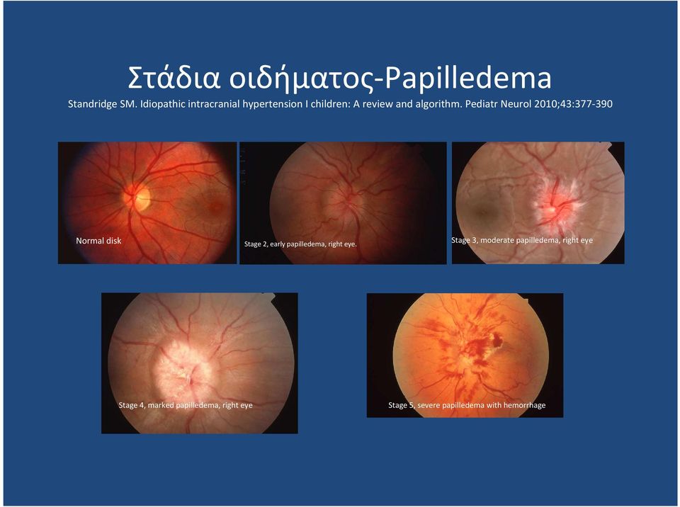 Pediatr Neurol 2010;43:377-390 Normal disk Stage 2, early papilledema, right eye.