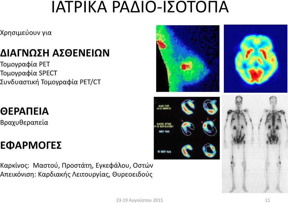 ΘΕΡΑΠΕΙΑ Βραχυθεραπεία ΕΦΑΡΜΟΓΕΣ Καρκίνος: Μαστού, Προστάτη,