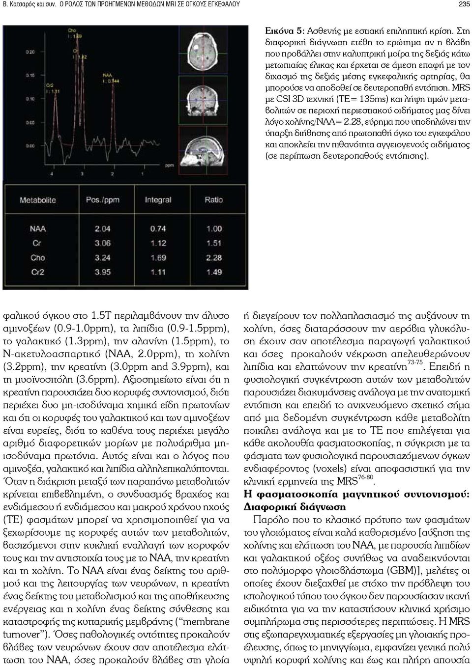 αρτηρίας, θα μπορούσε να αποδοθεί σε δευτεροπαθή εντόπιση. MRS με CSI 3D τεχνική (TE= 135ms) και λήψη τιμών μεταβολιτών σε περιοχή περιεστιακού οιδήματος μας δίνει λόγο χολίνης/ναα= 2.