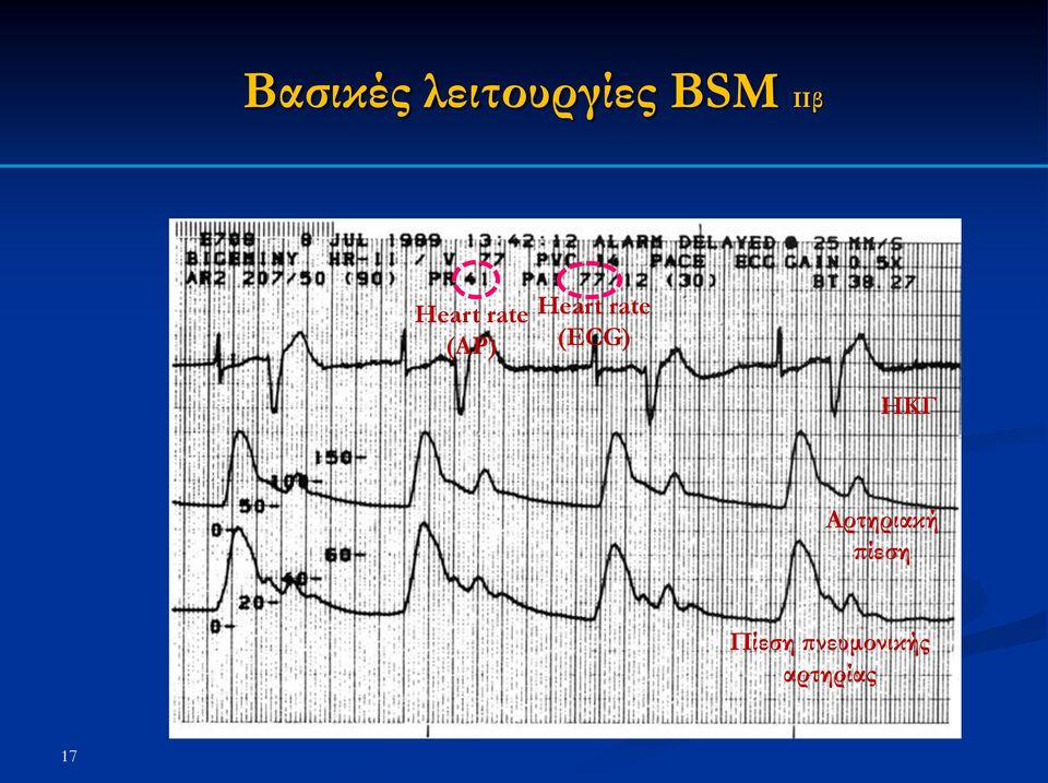 (ECG) ΗΚΓ Αρτηριακή πίεση