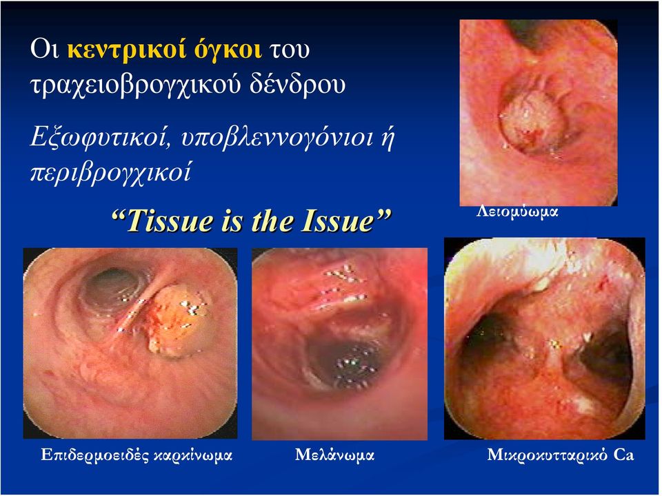 περιβρογχικοί Tissue is the Issue