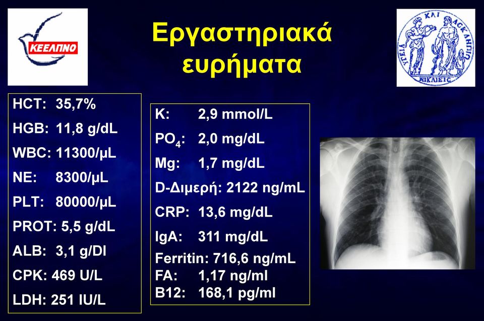 2,9 mmol/l PO 4 : 2,0 mg/dl Mg: 1,7 mg/dl D-Διμερή: 2122 ng/ml CRP: 13,6