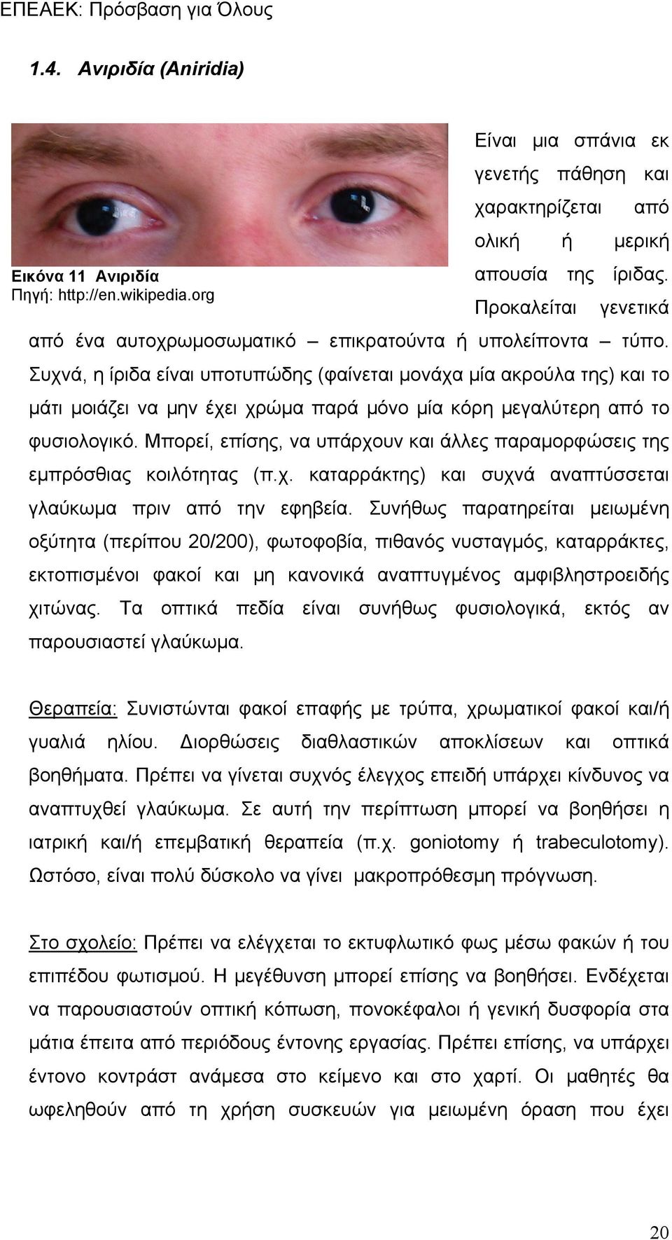 Συχνά, η ίριδα είναι υποτυπώδης (φαίνεται μονάχα μία ακρούλα της) και το μάτι μοιάζει να μην έχει χρώμα παρά μόνο μία κόρη μεγαλύτερη από το φυσιολογικό.