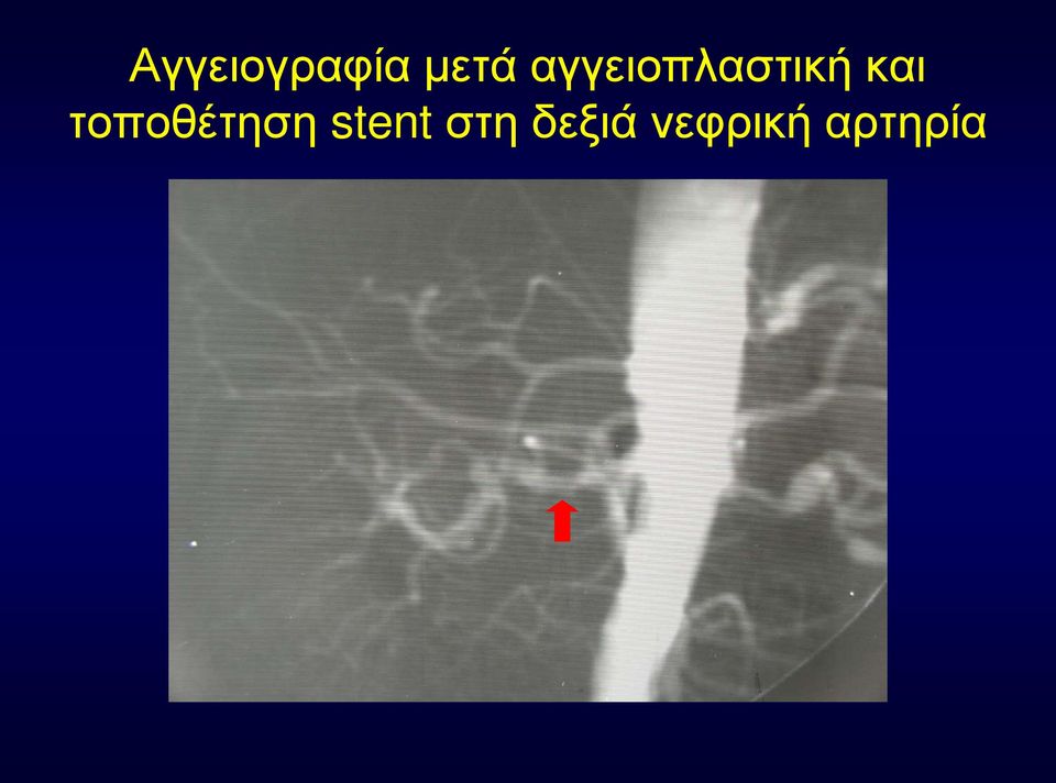 τοποθέτηση stent