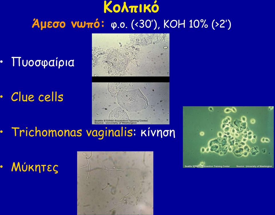 Πυοσφαίρια Clue cells