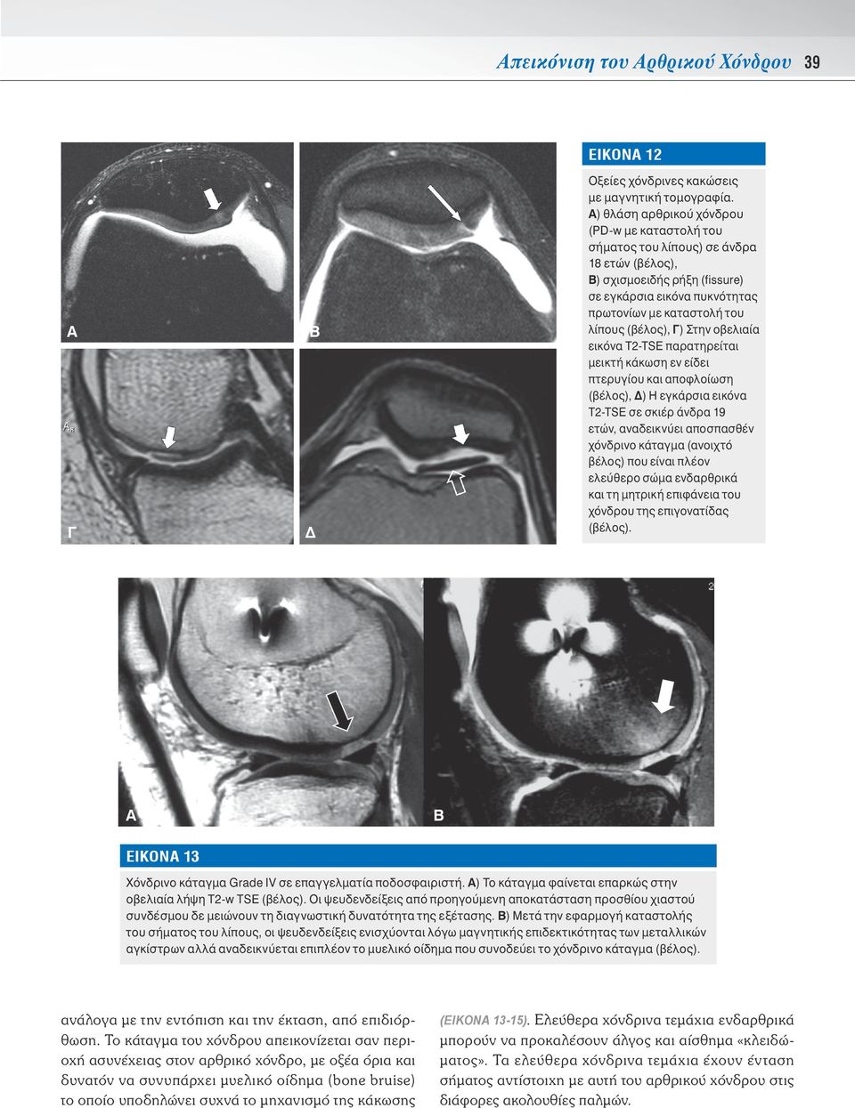 Γ) Στην οβελιαία εικόνα Τ2-ΤSE παρατηρείται μεικτή κάκωση εν είδει πτερυγίου και αποφλοίωση (βέλος), Δ) Η εγκάρσια εικόνα Τ2-TSE σε σκιέρ άνδρα 19 ετών, αναδεικνύει αποσπασθέν χόνδρινο κάταγμα