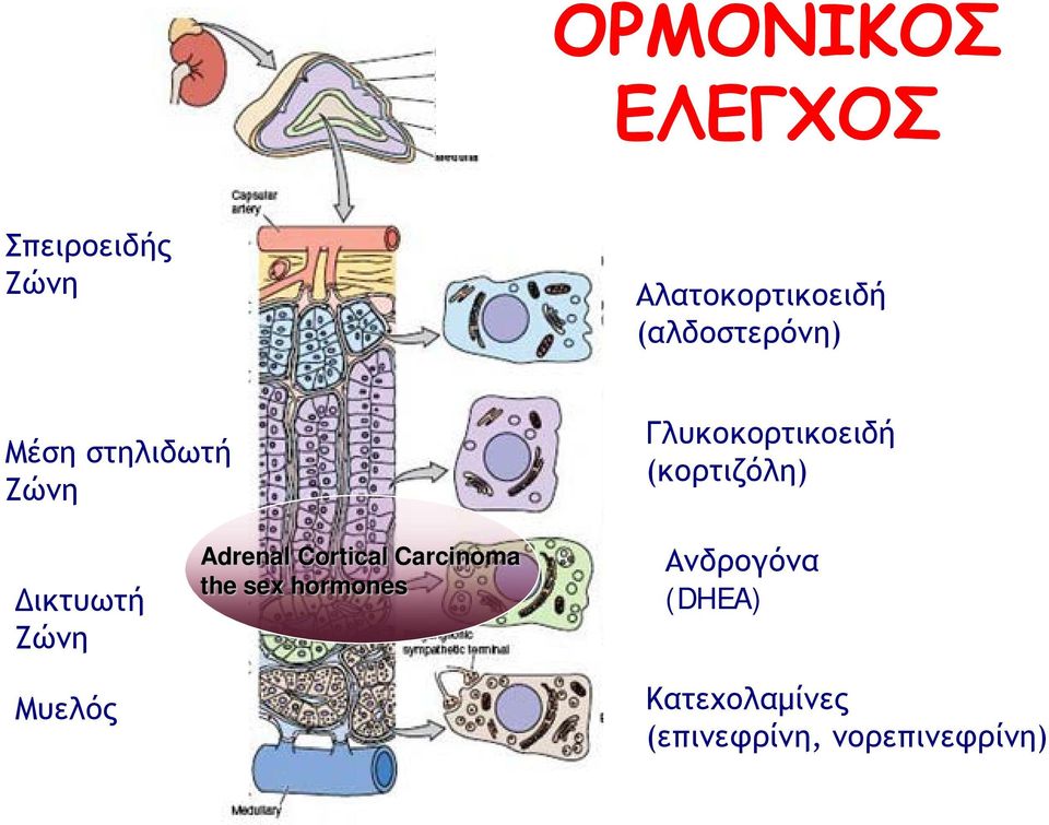 (κορτιζόλη) Δικτυωτή Ζώνη Μυελός Adrenal Cortical Carcinoma