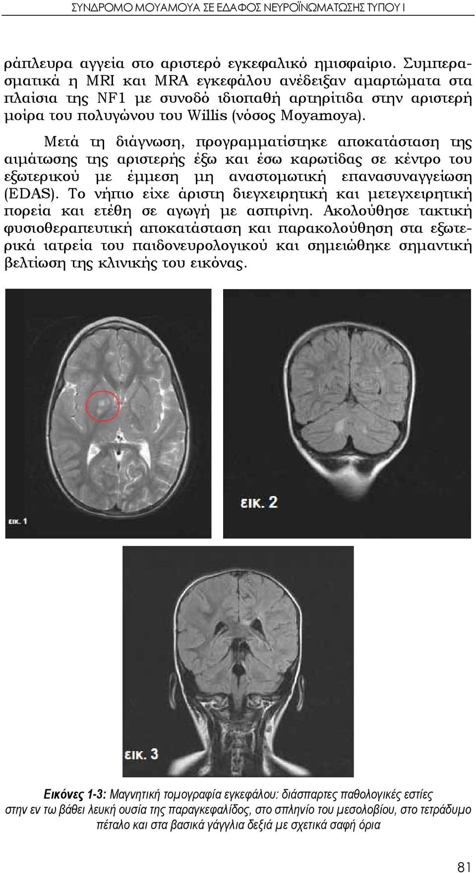 Μετά τη διάγνωση, προγραμματίστηκε αποκατάσταση της αιμάτωσης της αριστερής έξω και έσω καρωτίδας σε κέντρο του εξωτερικού με έμμεση μη αναστομωτική επανασυναγγείωση (EDAS).