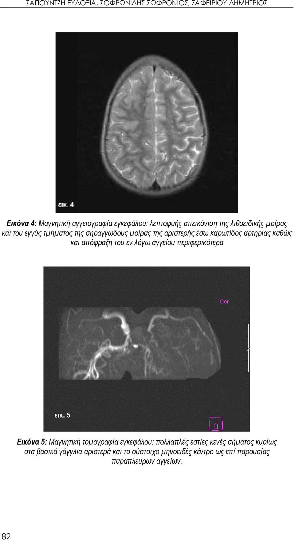 καθώς και απόφραξη του εν λόγω αγγείου περιφερικότερα Εικόνα 5: Μαγνητική τομογραφία εγκεφάλου: πολλαπλές εστίες