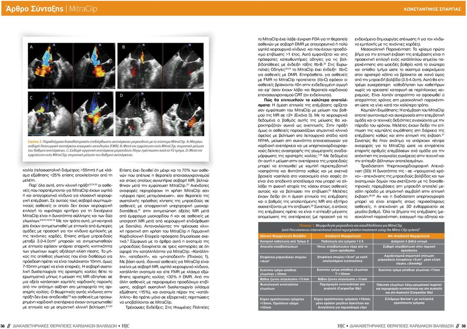 C: Σοβαρή οργανική ανεπάρκεια μιτροειδούς λόγω πρόπτωσης κατά το P2 τμήμα. D: Μετά την εμφύτευση ενός MitraClip, σημαντική μείωση του βαθμού ανεπάρκειας.
