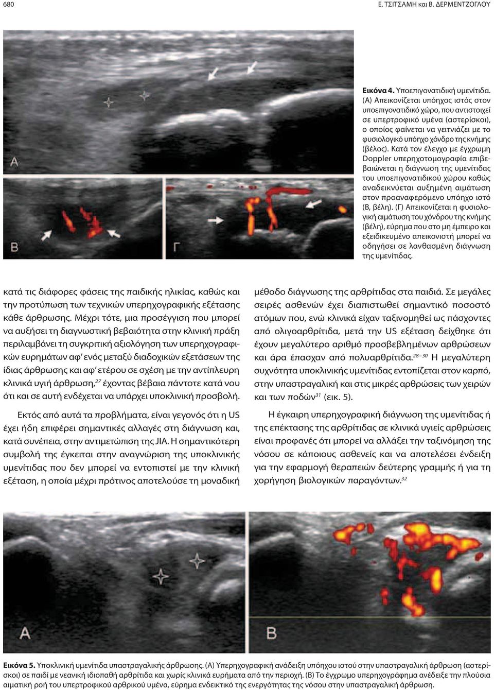 Κατά τον έλεγχο με έγχρωμη Doppler υπερηχοτομογραφία επιβεβαιώνεται η διάγνωση της υμενίτιδας του υποεπιγονατιδικού χώρου καθώς αναδεικνύεται αυξημένη αιμάτωση στον προαναφερόμενο υπόηχο ιστό (Β,