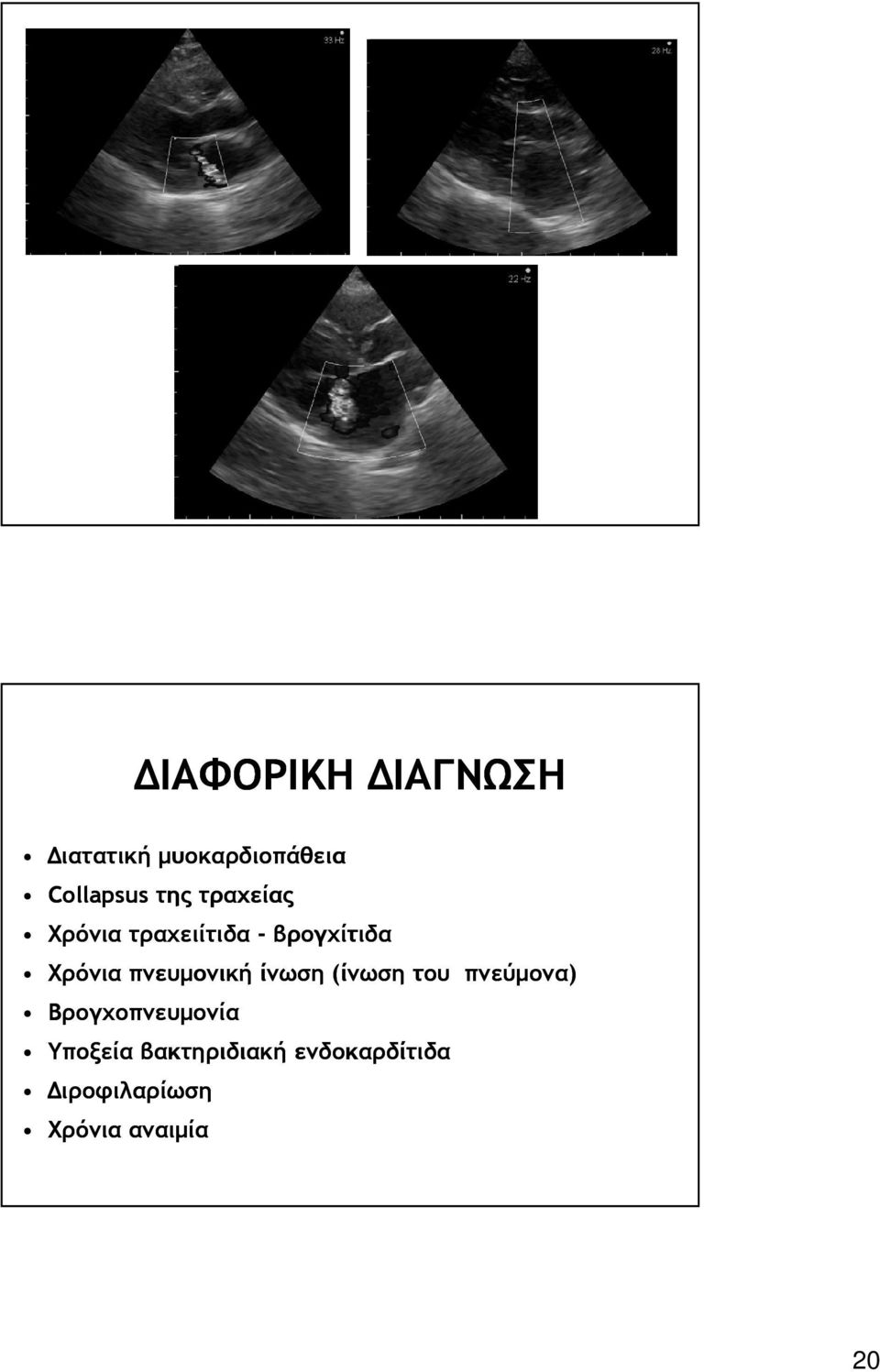 πνευµονική ίνωση (ίνωση του πνεύµονα) Βρογχοπνευµονία