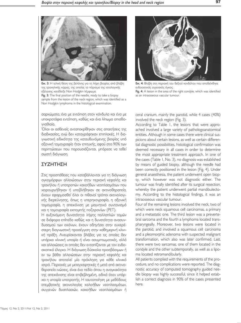 3: The final position of the needle, ready to take a biopsy sample from the lesion of the neck region, which was identified as a Non Hodgkin lymphoma in the histological examination. Εικ.