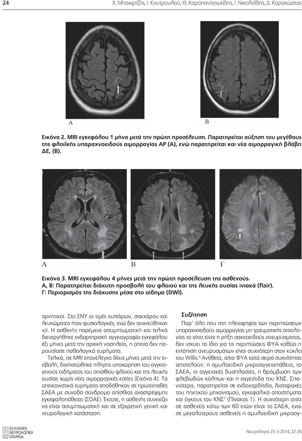 MRI εγκεφάλου 4 μήνες μετά την πρώτη προσέλευση της ασθενούς. Α, Β: Παρατηρείται διάχυτη προσβολή του φλοιού και της λευκής ουσίας ινιακά (flair). Γ: Περιορισμός της διάχυσης μέσα στο οίδημα (DWI).