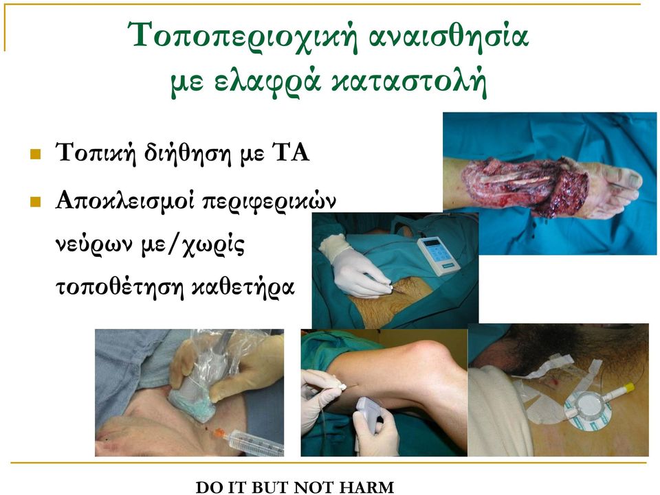 Αποκλεισµοί περιφερικών νεύρων