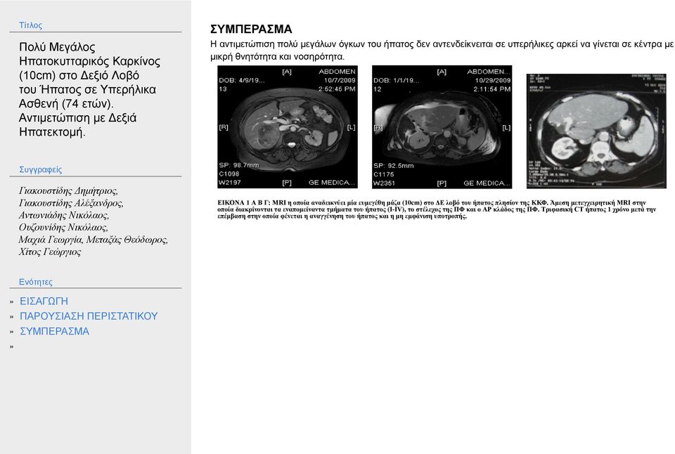 Άμεση μετεγχειρητική MRI στην οποία διακρίνονται τα εναπομείναντα τμήματα του ήπατος (I-IV), το στέλεχος της ΠΦ και ο ΑΡ κλάδος της ΠΦ.