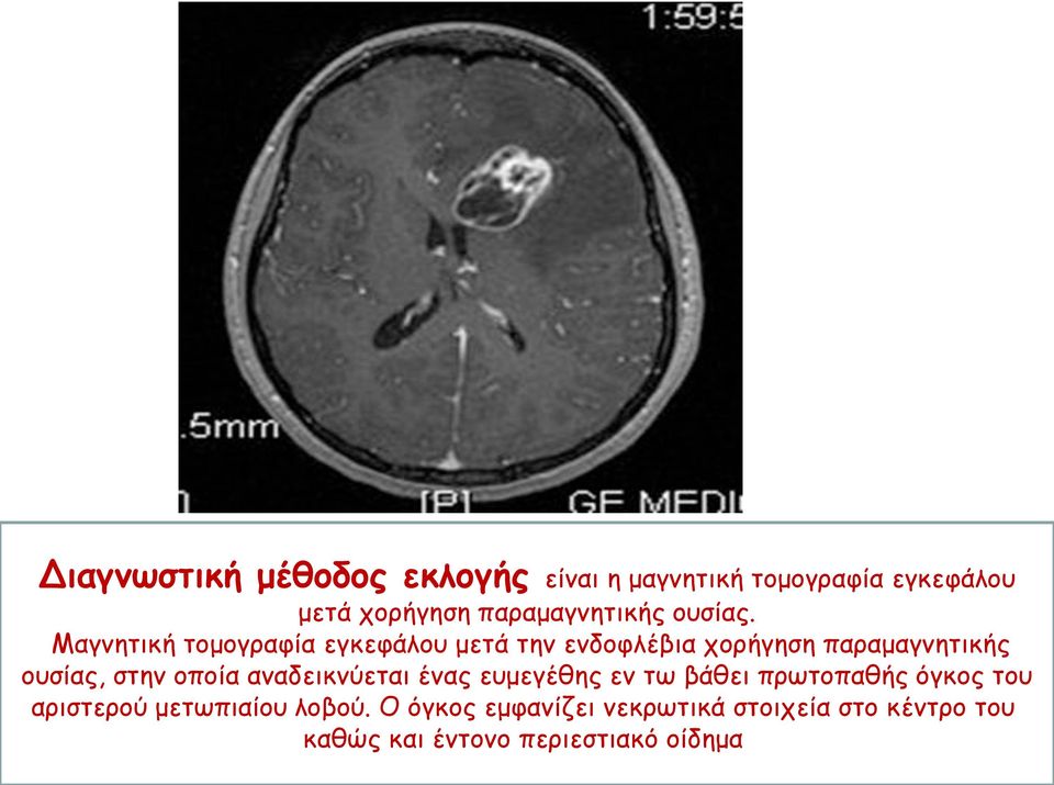 Μαγνητική τομογραφία εγκεφάλου μετά την ενδοφλέβια χορήγηση παραμαγνητικής ουσίας, στην οποία