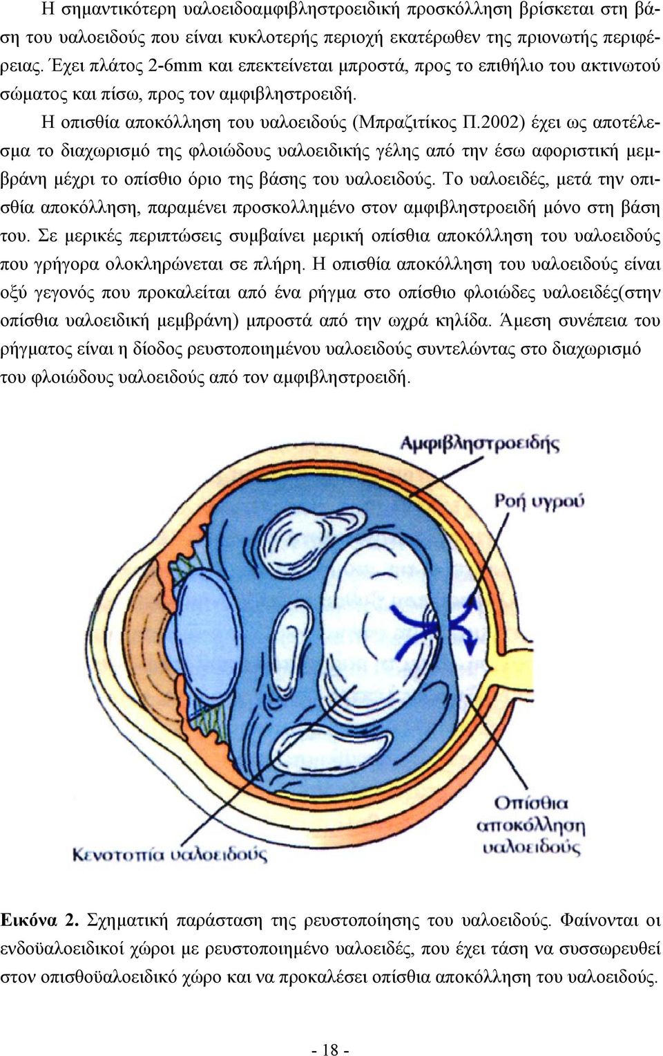 2002) έχει ως αποτέλεσµα το διαχωρισµό της φλοιώδους υαλοειδικής γέλης από την έσω αφοριστική µεµβράνη µέχρι το οπίσθιο όριο της βάσης του υαλοειδούς.