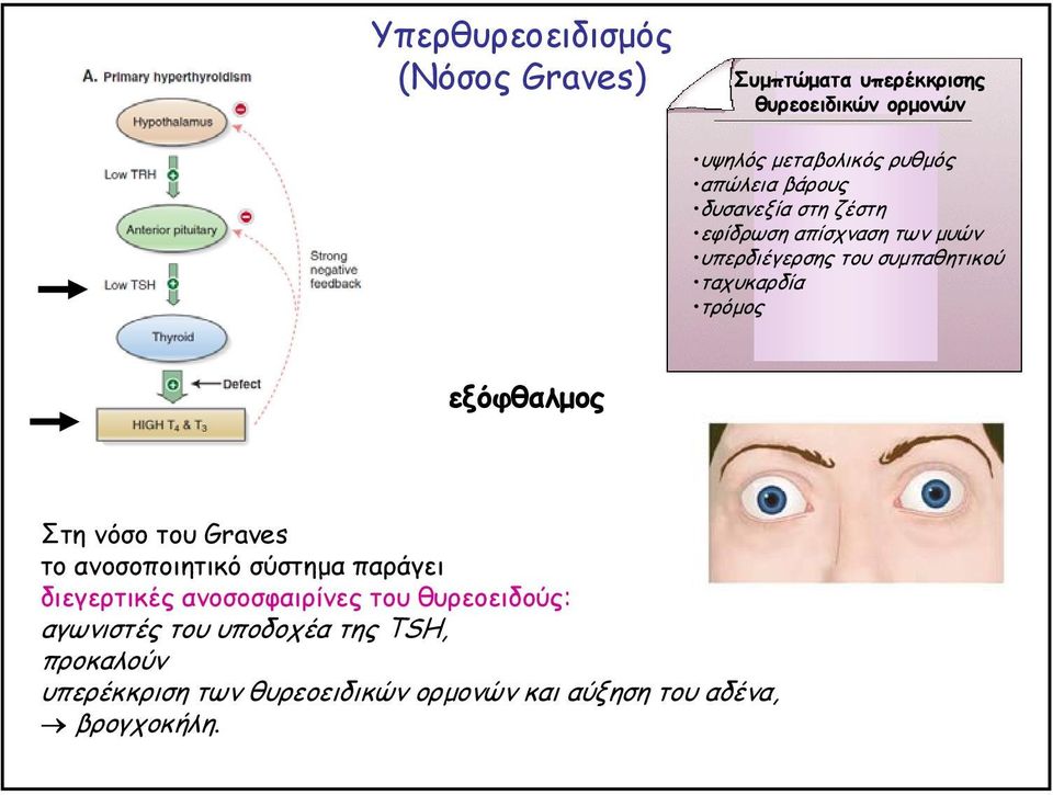 τρόµος εξόφθαλµος Στη νόσο του Graves το ανοσοποιητικό σύστηµα παράγει διεγερτικές ανοσοσφαιρίνες του