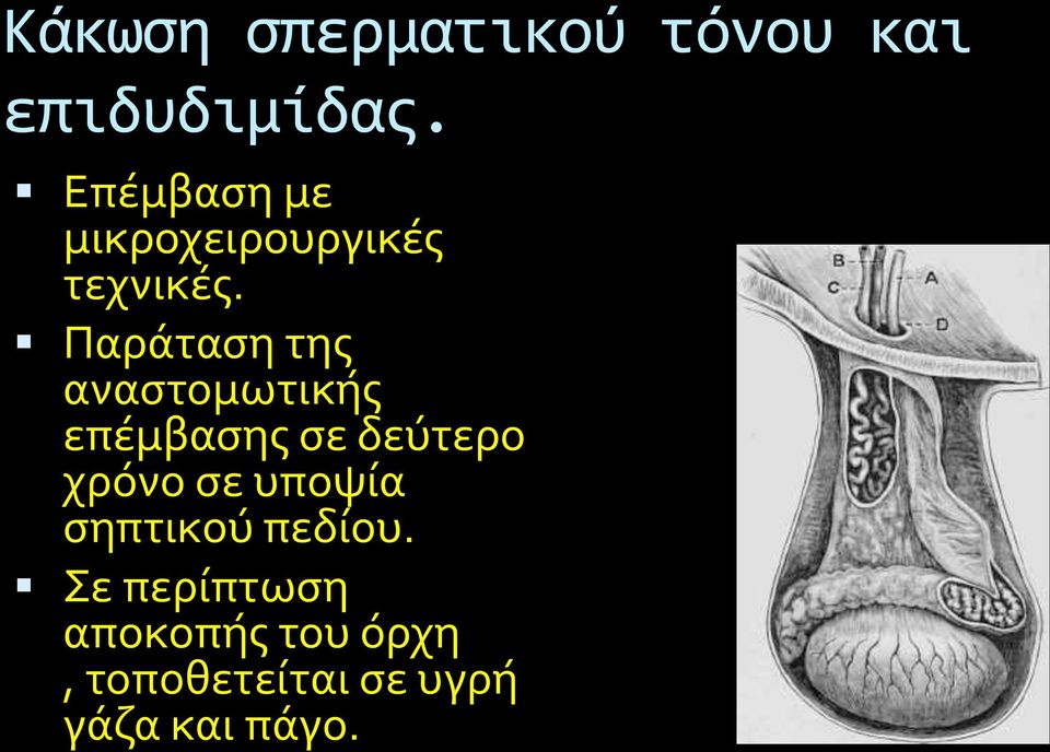 Παρϊταςη τησ αναςτομωτικόσ επϋμβαςησ ςε δεύτερο χρόνο ςε