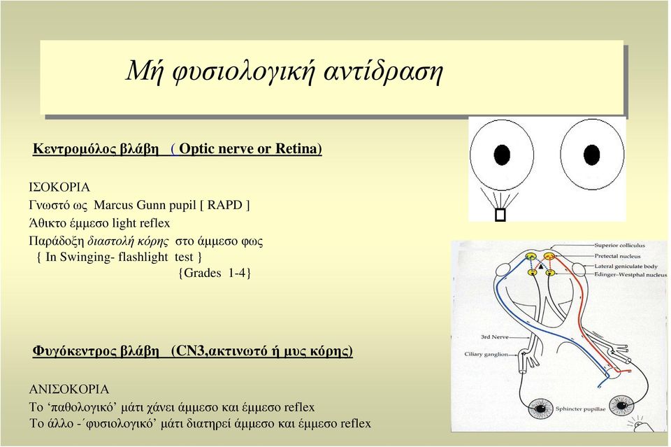 flashlight test } {Grades 1-4} Φυγόκεντρος βλάβη (CN3,ακτινωτό ή µυς κόρης) ΑΝΙΣΟΚΟΡΙΑ Το