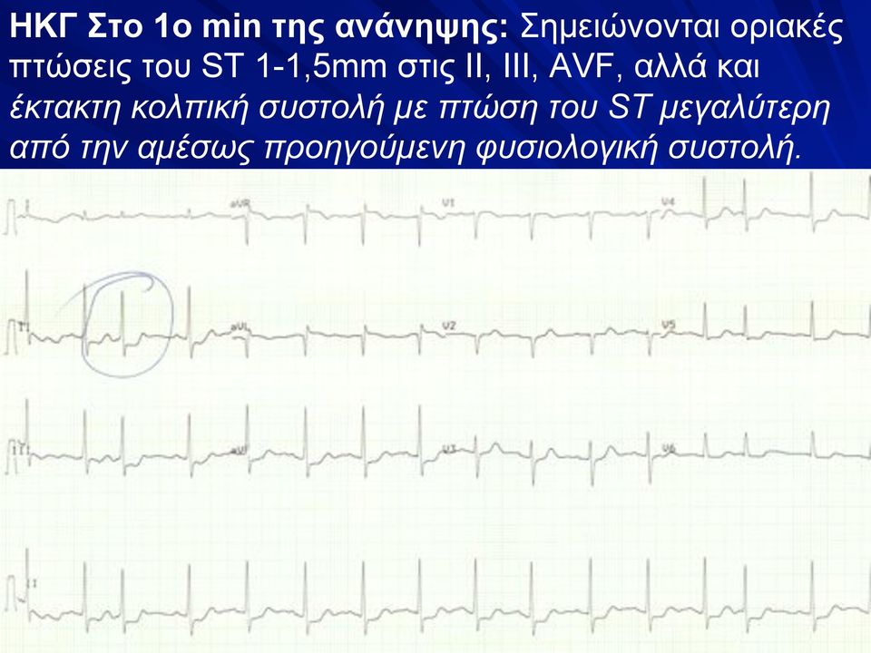 και έκτακτη κολπική συστολή µε πτώση του ST