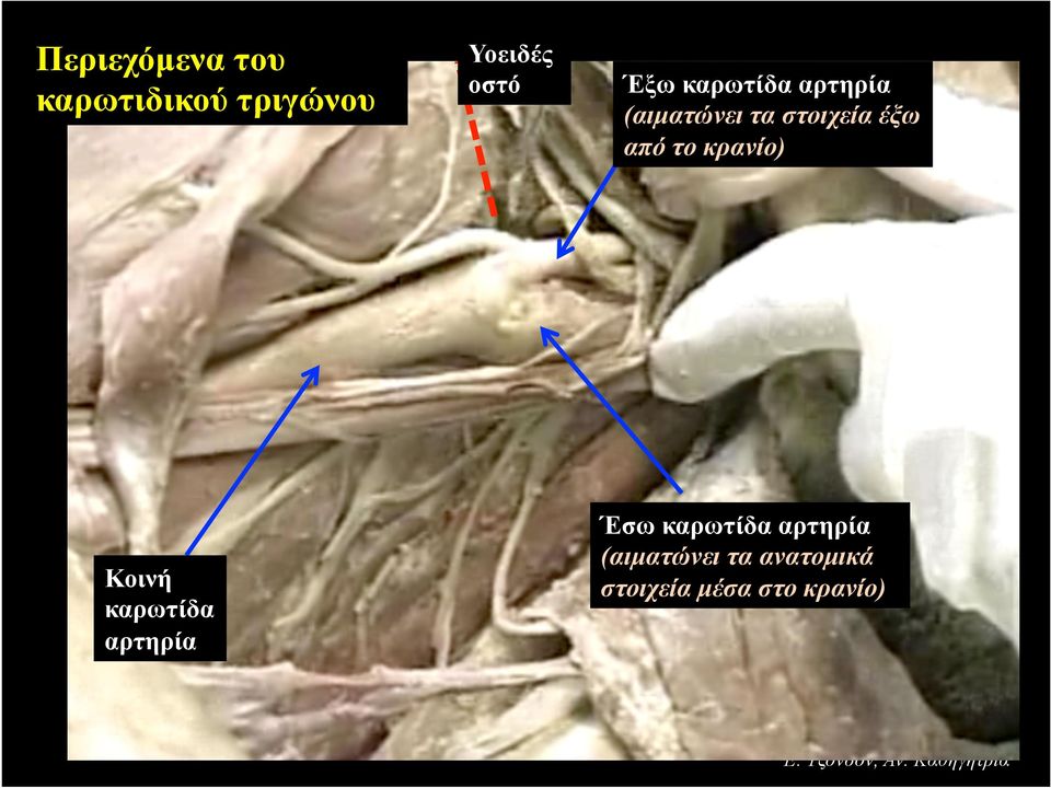 το κρανίο) Κοινή καρωτίδα αρτηρία Έσω καρωτίδα