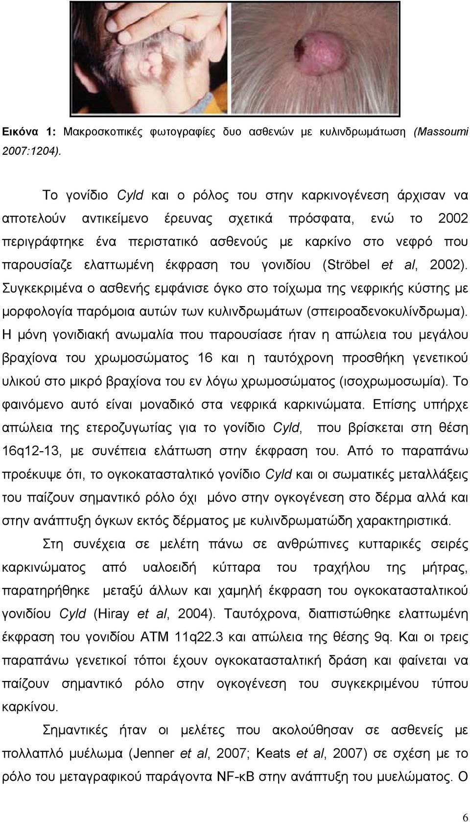 ελαττωμένη έκφραση του γονιδίου (Ströbel et al, 2002). Συγκεκριμένα ο ασθενής εμφάνισε όγκο στο τοίχωμα της νεφρικής κύστης με μορφολογία παρόμοια αυτών των κυλινδρωμάτων (σπειροαδενοκυλίνδρωμα).