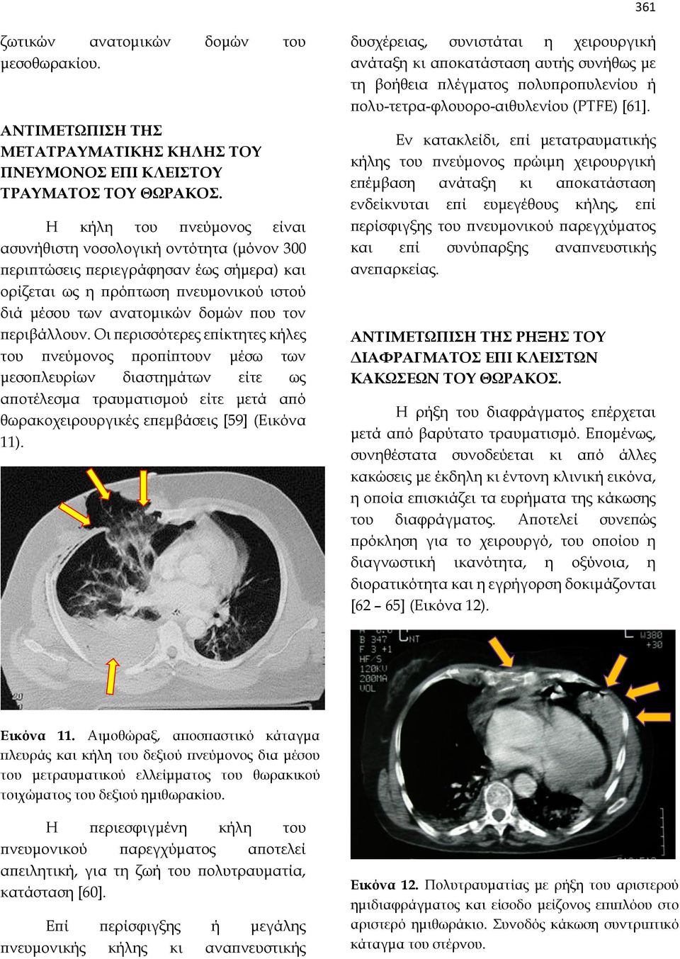 περιβάλλουν. Οι περισσότερες επίκτητες κήλες του πνεύμονος προπίπτουν μέσω των μεσοπλευρίων διαστημάτων είτε ως αποτέλεσμα τραυματισμού είτε μετά από θωρακοχειρουργικές επεμβάσεις [59] (Εικόνα 11).