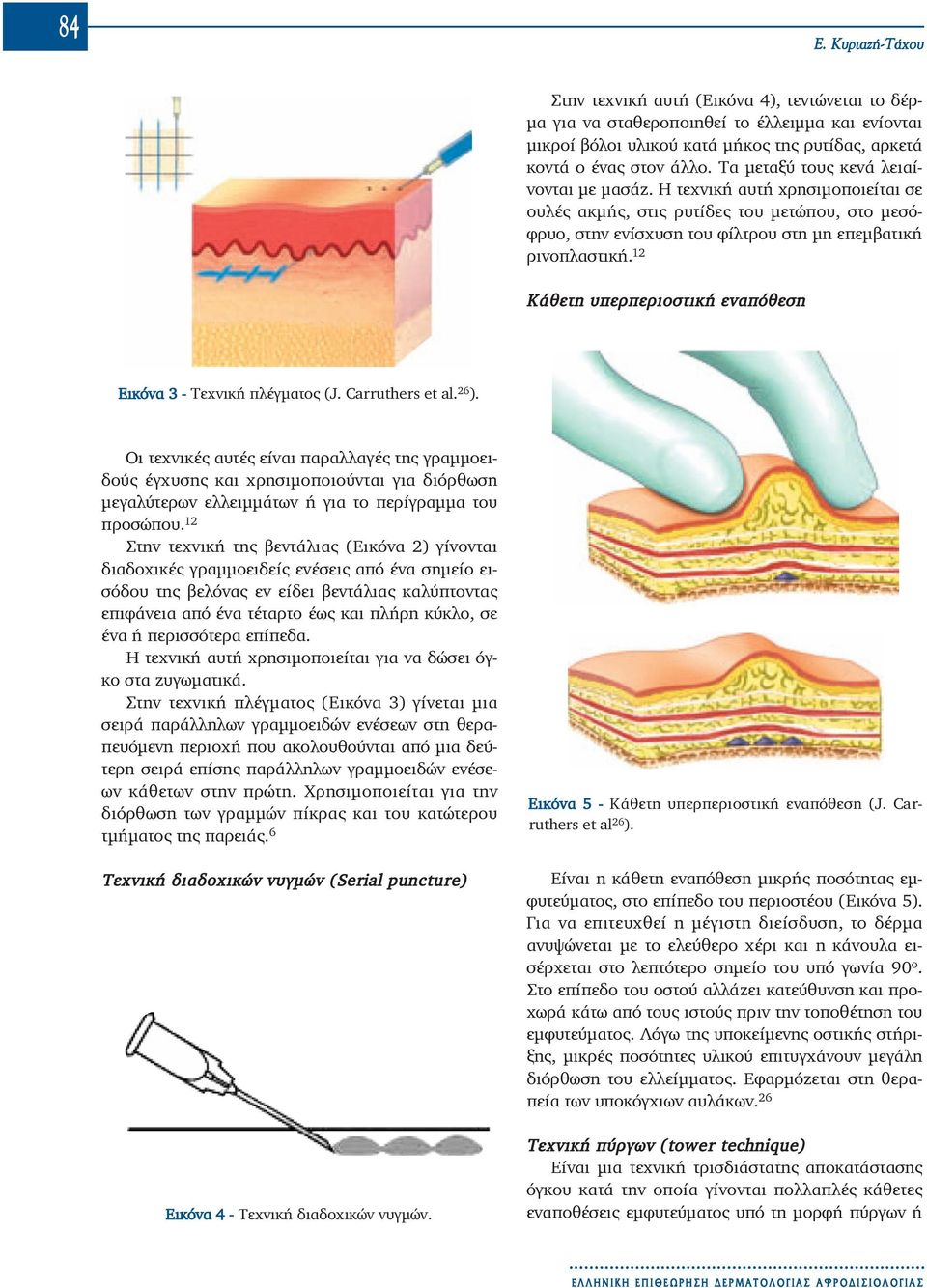 12 Κάθετη υπερπεριοστική εναπόθεση Åé êü íá 3 - Τεχνική πλέγματος (J. Carruthers et al. 26 ).