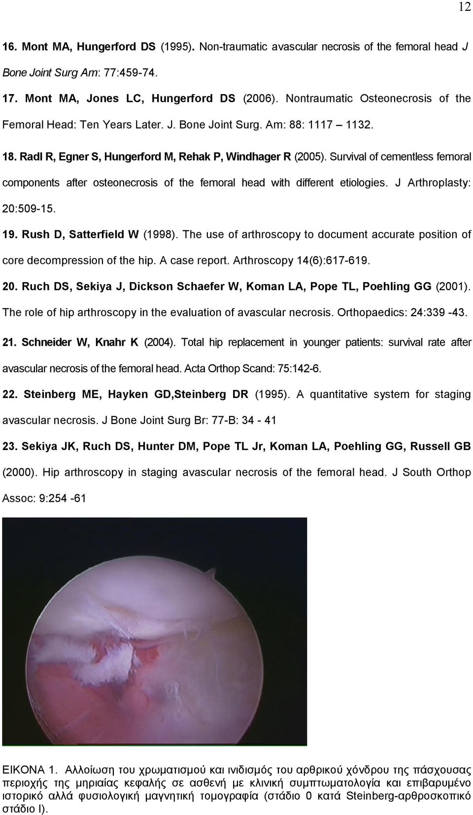 Survival of cementless femoral components after osteonecrosis of the femoral head with different etiologies. J Arthroplasty: 20:509-15. 19. Rush D, Satterfield W (1998).